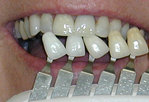 color match for whitening